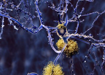 New Alzheimer’s study suggests genetic cause of specific form of disease